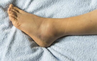 SI TE DAS UN GOLPE EN EL PIE, ATACAS LA HINCHAZÓN CON QUIMIOTERAPIA?
