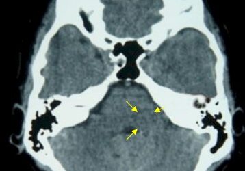 La Tomografía Cerebral sin Contraste: Una Clave Diagnóstica en la Germanische Heilkunde